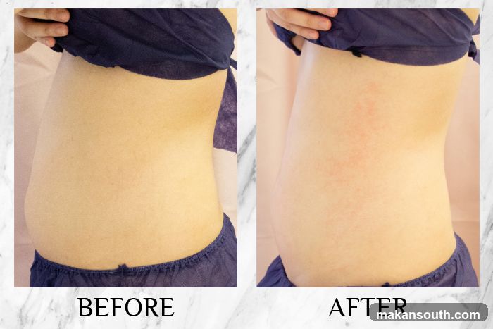 Before and After Skin Treatment Comparison